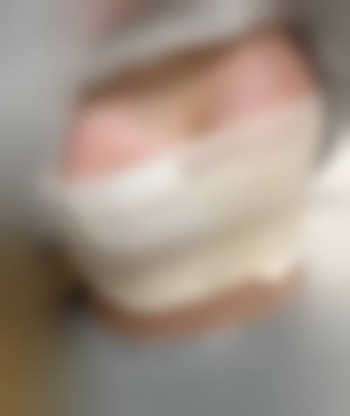 影响胸部假体是否取出的因素