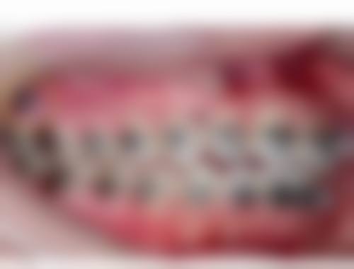 乌鲁木齐牙博士口腔：发现牙齿拥挤不齐的困扰