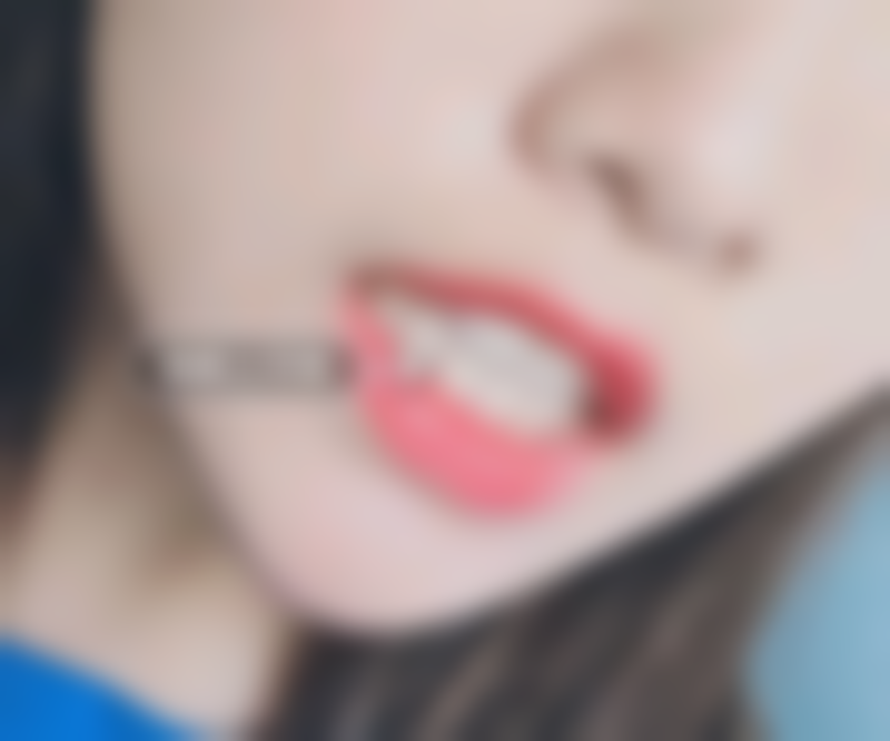 乌鲁木齐牙博士口腔正雅隐形矫正经历分享：牙齿拥挤不齐，靠隐形矫正重塑整齐美牙