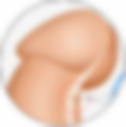 小腿吸脂手术的其他潜在危害