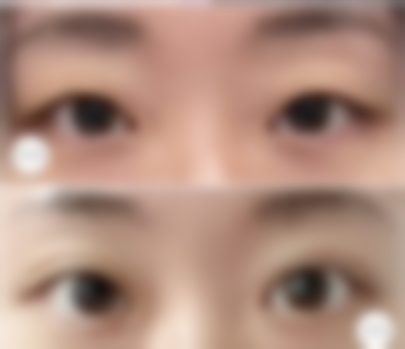 20年前注射隆胸材料的风险有哪些