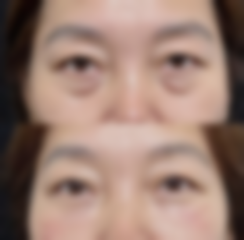 隆胸手术前要做哪些准备