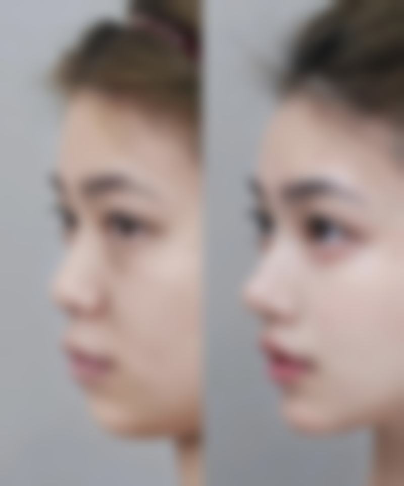 自体脂肪丰臀有啥缺点