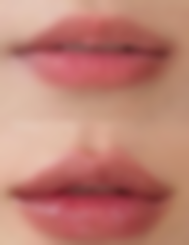 毛囊分离和培养是怎么回事