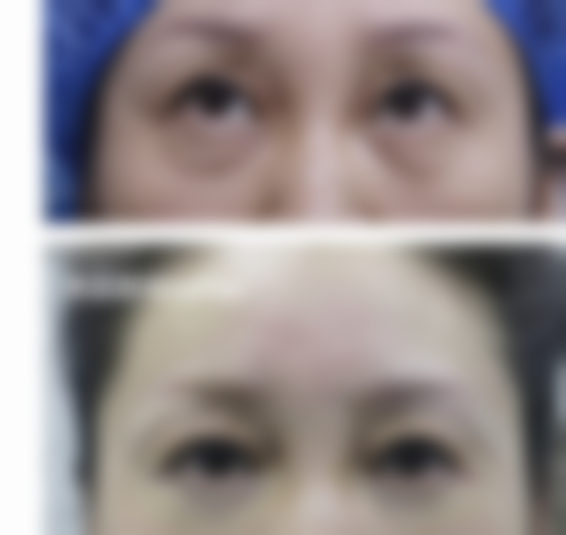 毛囊种植是如何进行的