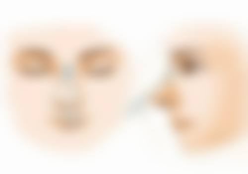 奥美定隆鼻副作用有什么？感染、硬结、变形、疼痛、取出难等问题会出现吗