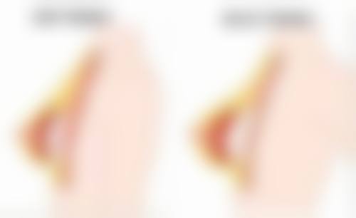 隆胸老了后遗症有多少