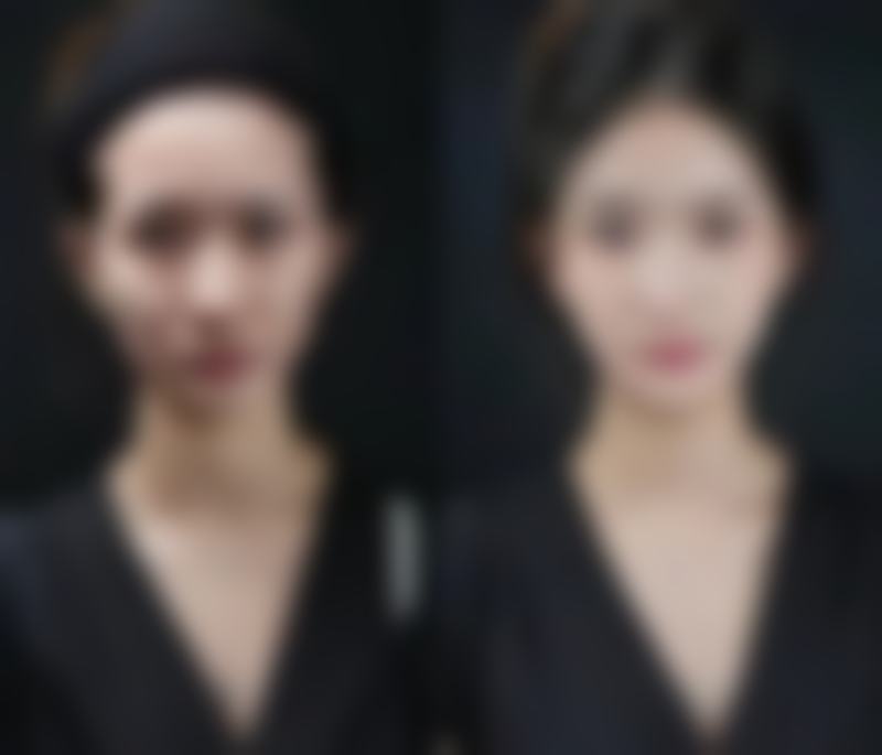 总结打针隆鼻可以维持多久