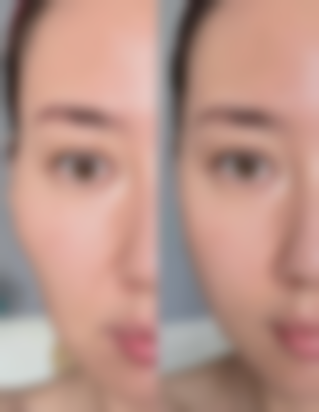 奥美定隆鼻导致鼻子变形的情况有哪些