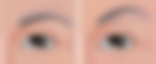 38岁去眼袋选择医院的要点