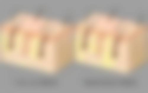 头发种植中的麻醉环节