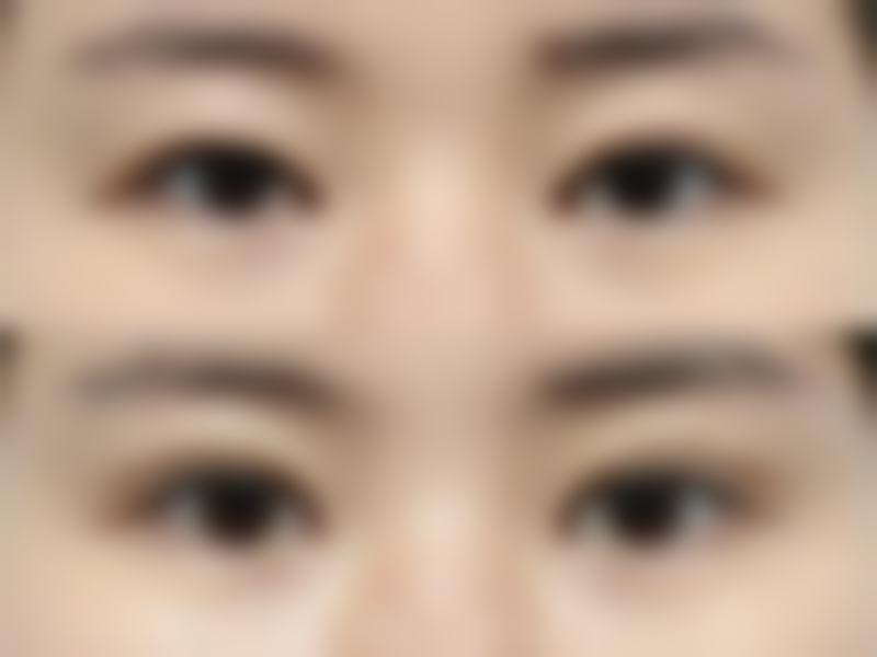 38岁手术去眼袋的方法