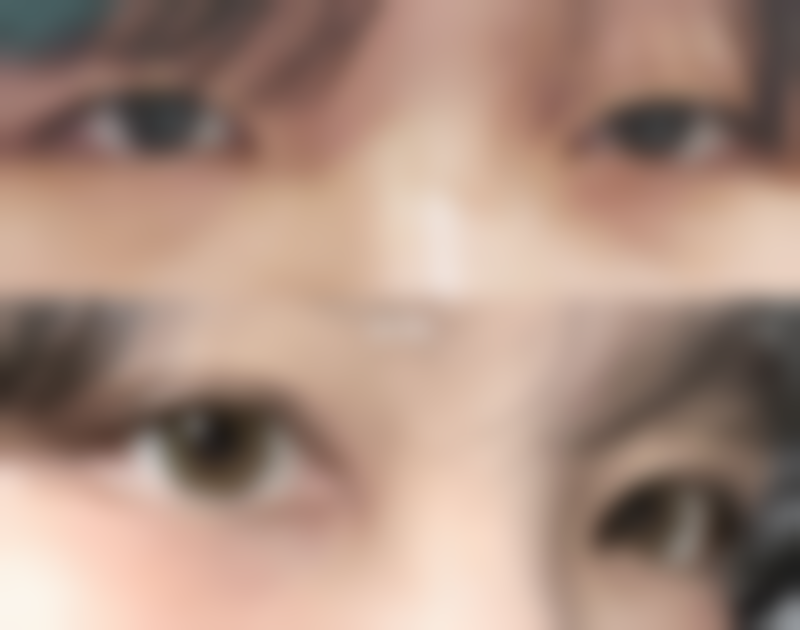 牙齿矫正改善嘴部外观