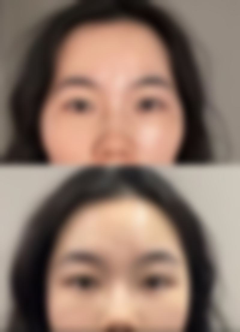 术后护理对消肿时间的影响