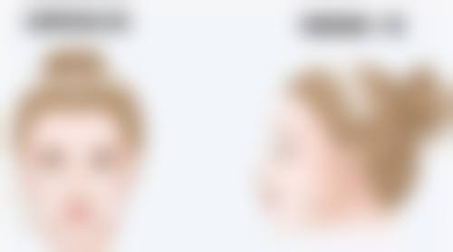 隆胸假体会出现破裂的情况