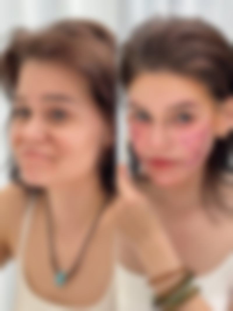 童颜针丰太阳穴能保持多久