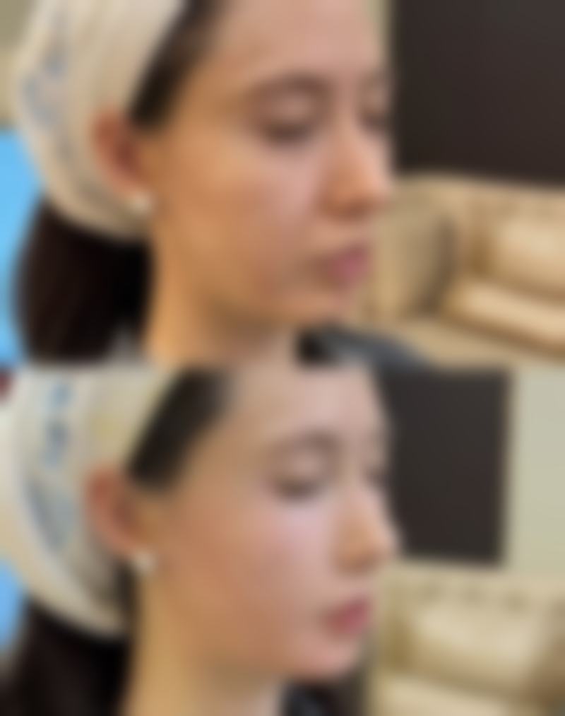 骨粉隆鼻可以取出吗