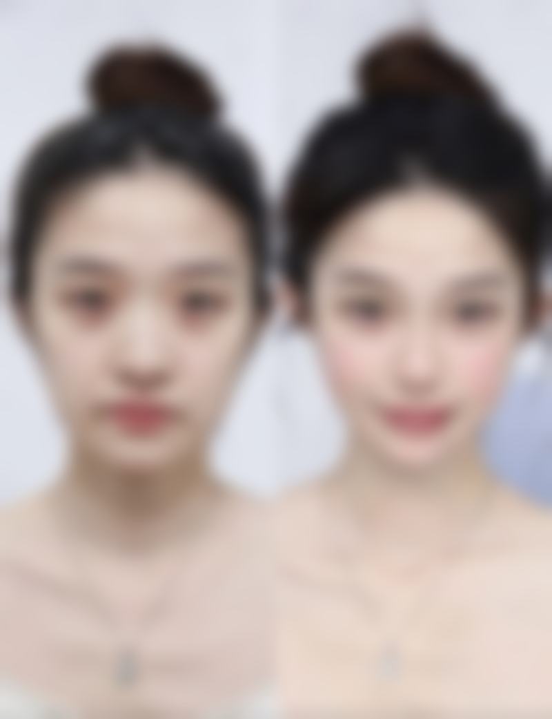 骨粉隆鼻取出需要几次才能干净