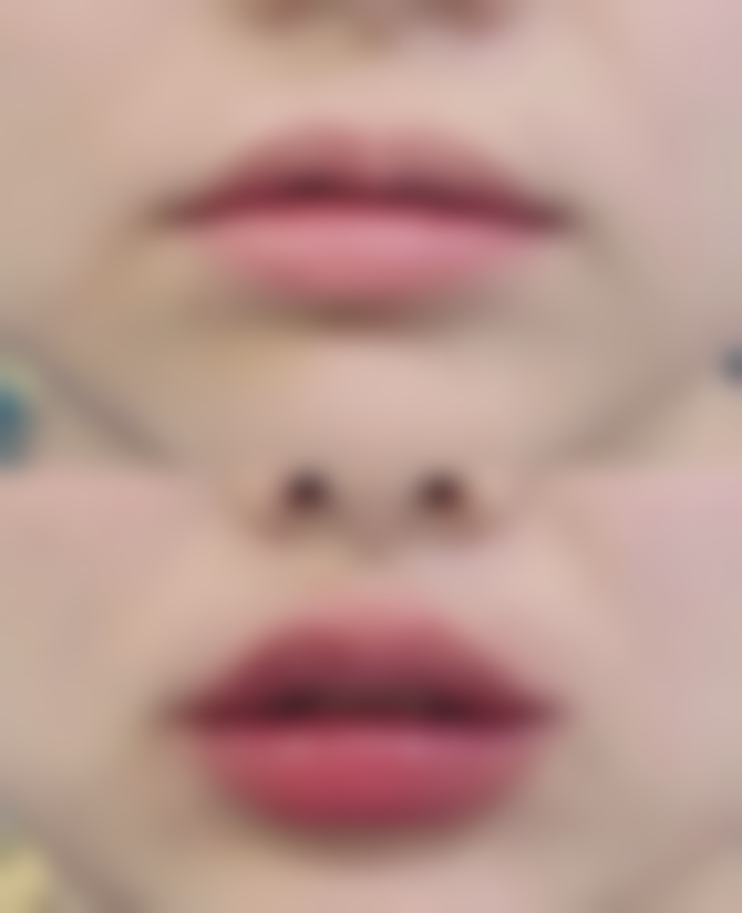 整容把嘴唇整薄的手术成效如何