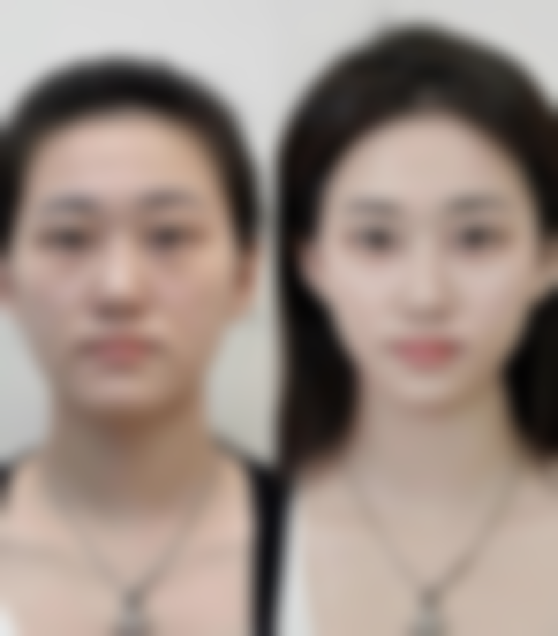 温州华悦医疗美容诊所覃金华医生技术好不好？