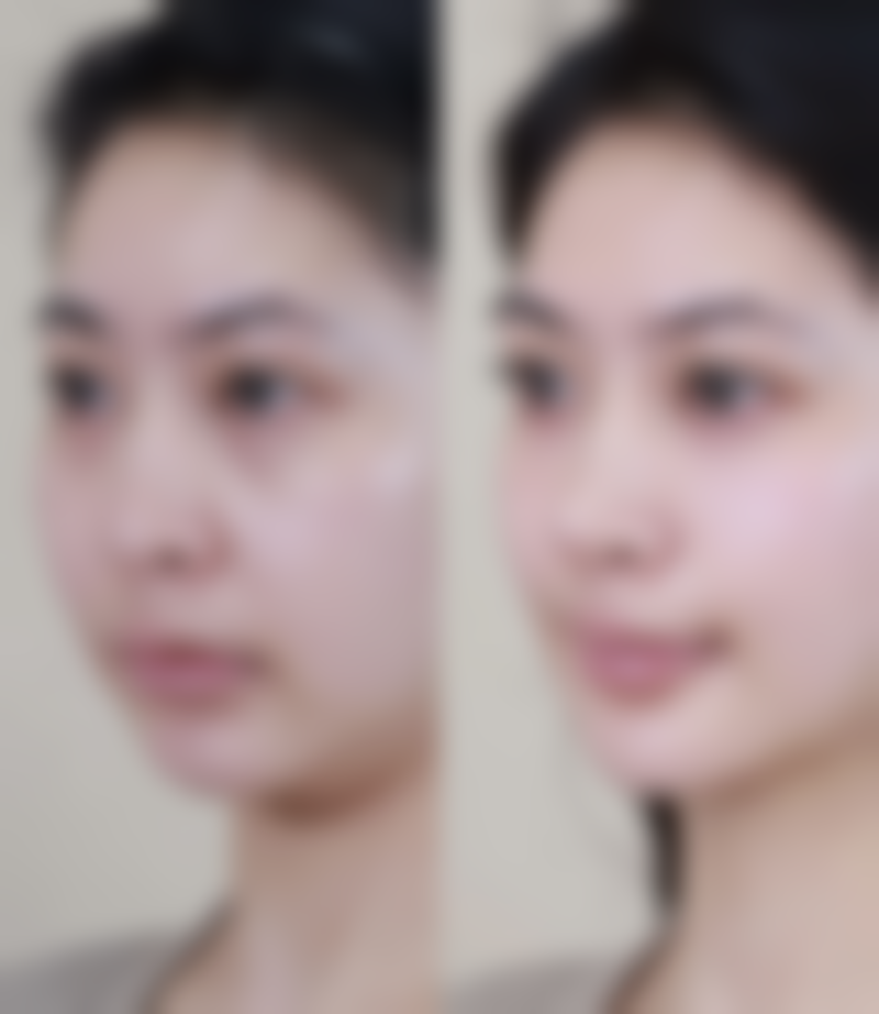 自体脂肪丰臀有危险吗？了解潜在风险与应对方法，助你安全拥有美臀