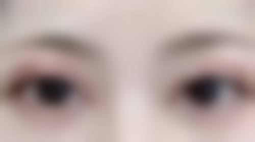 不同程度嘴凸的矫正方案