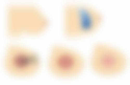 阴道收紧手术的成效和维持时间