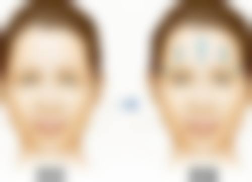 老年人怎么去眼袋？非手术、小偏方、手术及医美技术等方法任你选