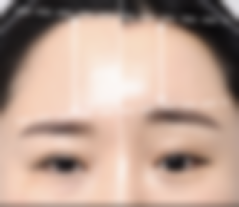 注射瘦脸针成效的维持时间