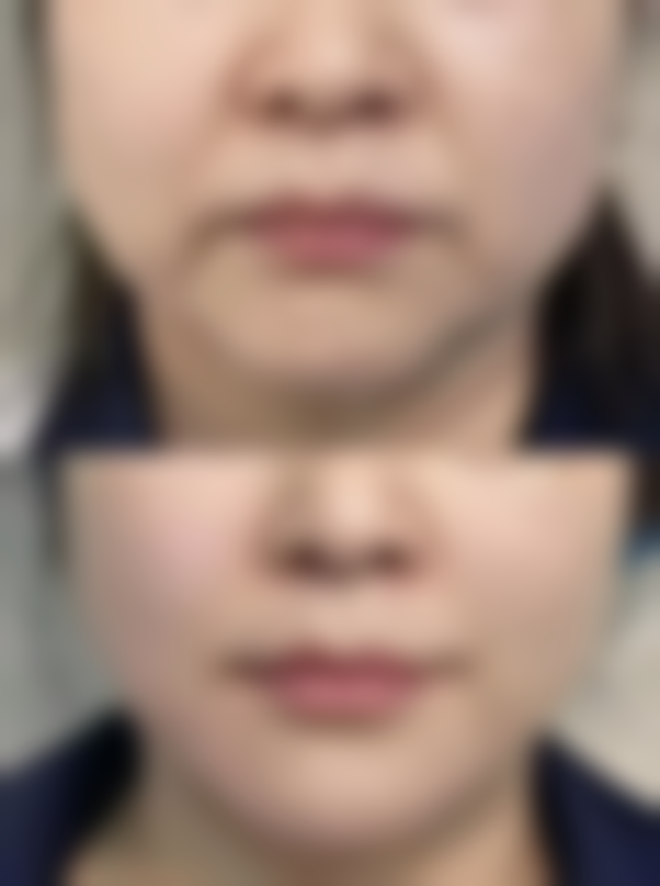 总结——长沙爱馨整形医院雷医生怎么样?