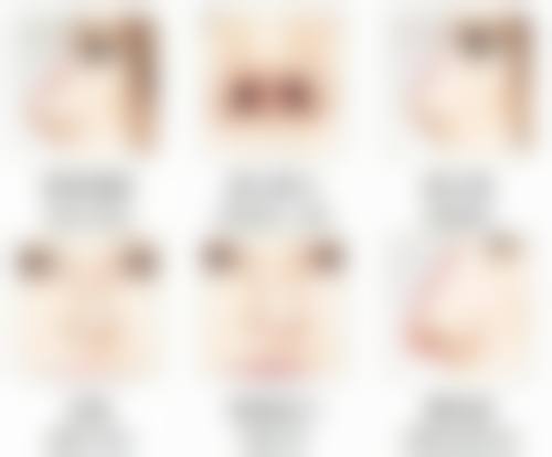 耳软骨隆鼻加硅胶鼻成效的维持时间总结