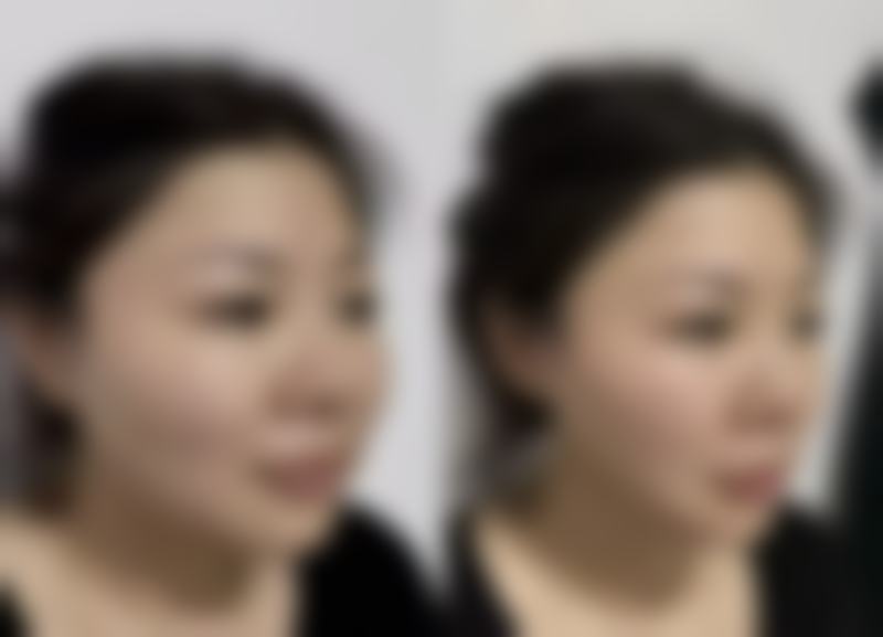 抽脂手术的风险与注意事项