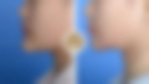 嘴巴宽大整形后如何护理