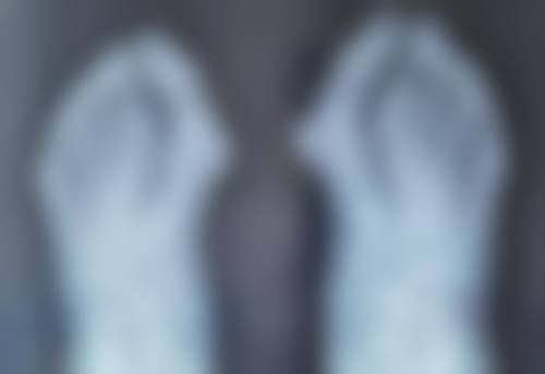 用什么丰太阳穴好？玻尿酸、自体脂肪、胶原蛋白、童颜针、假体植入各有优劣