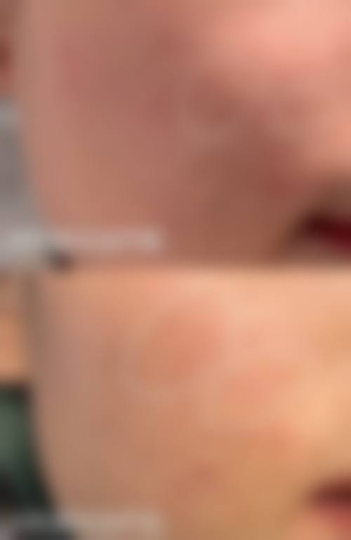 隆胸老了后遗症有哪些表现