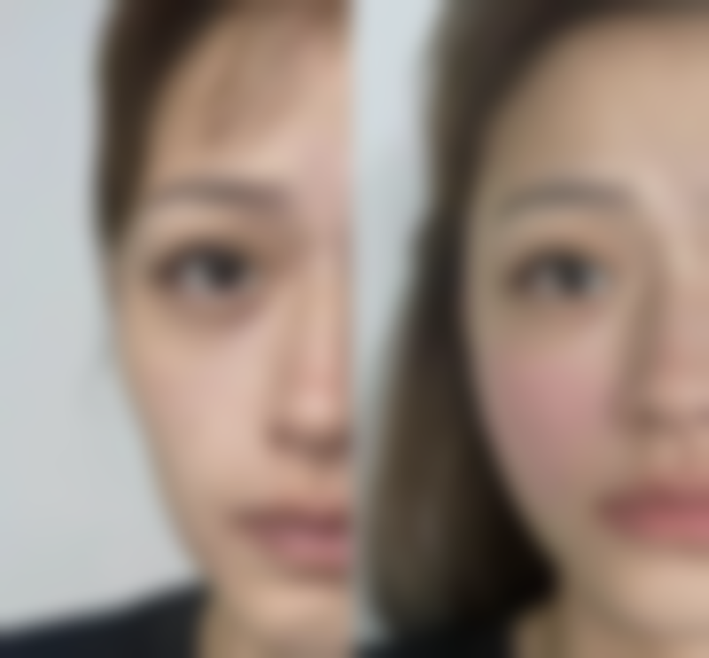 啵啵唇手术怎么样