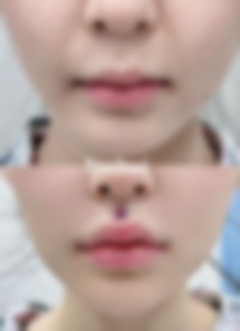 术后护理是怎么操作的