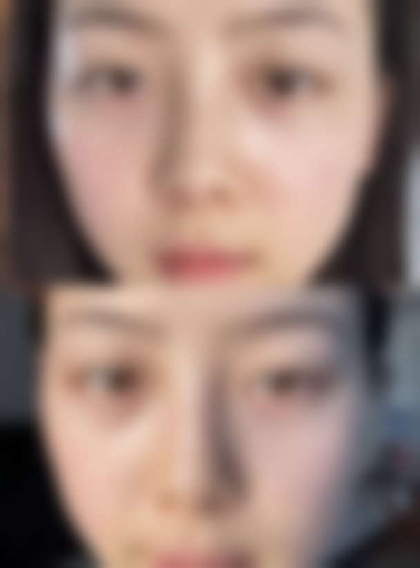 打玻尿酸隆鼻的注意事项