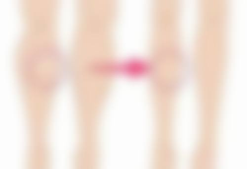 抽脂手术成效的持久性