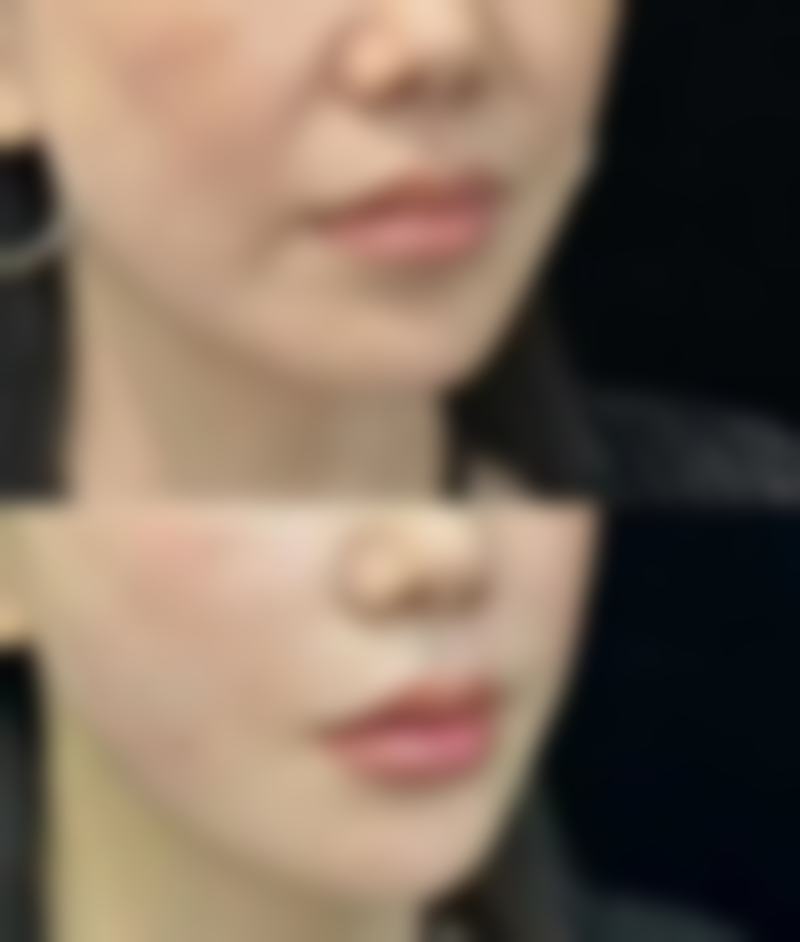 不同类型美白针对见效时间的影响