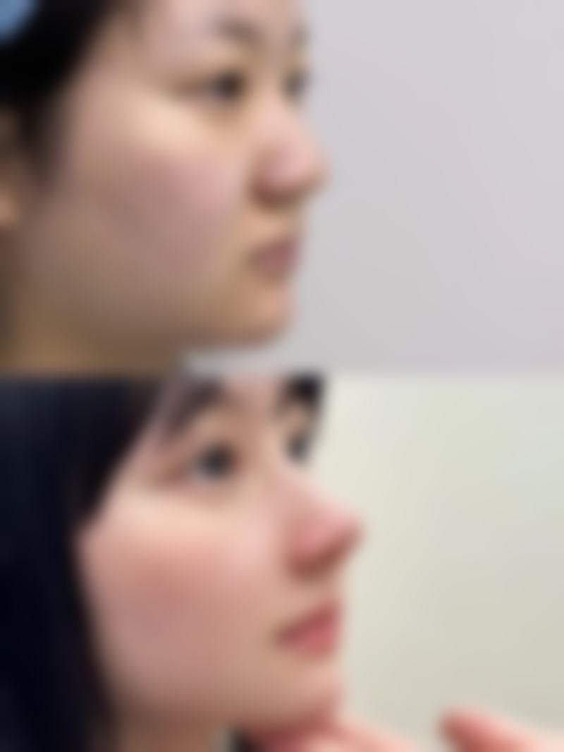 假体隆胸危害产生的原因