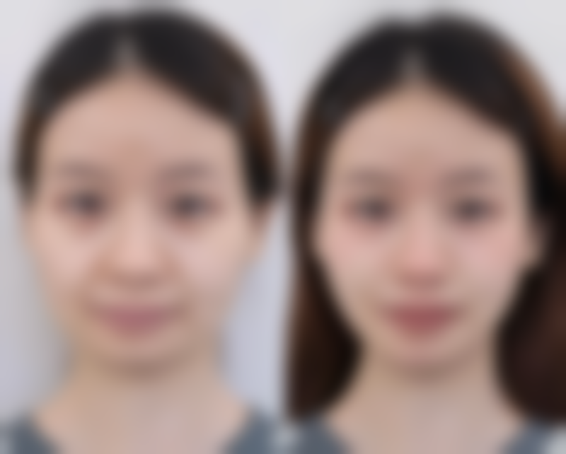 耳软骨隆鼻吸收的正常范围