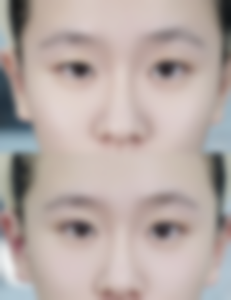 做嘴唇整形手术会留疤吗