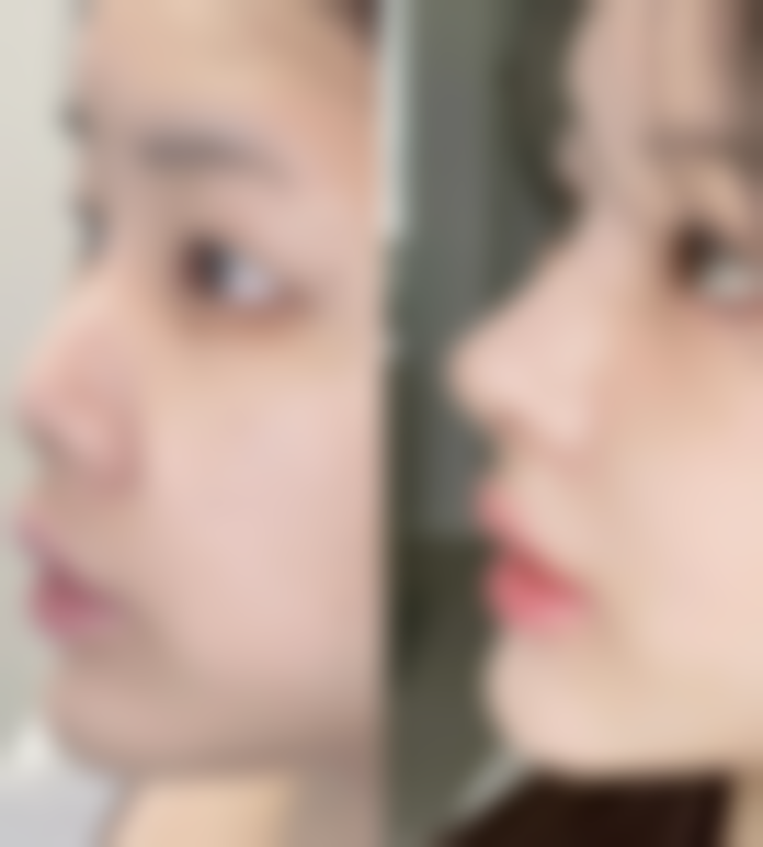 总结——福州爱美尔整形医院周金超医生怎么样?