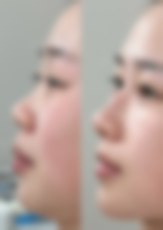 嘴唇太厚可以做整形吗？厚唇改薄等术式揭秘，风险、费用及护理全知晓