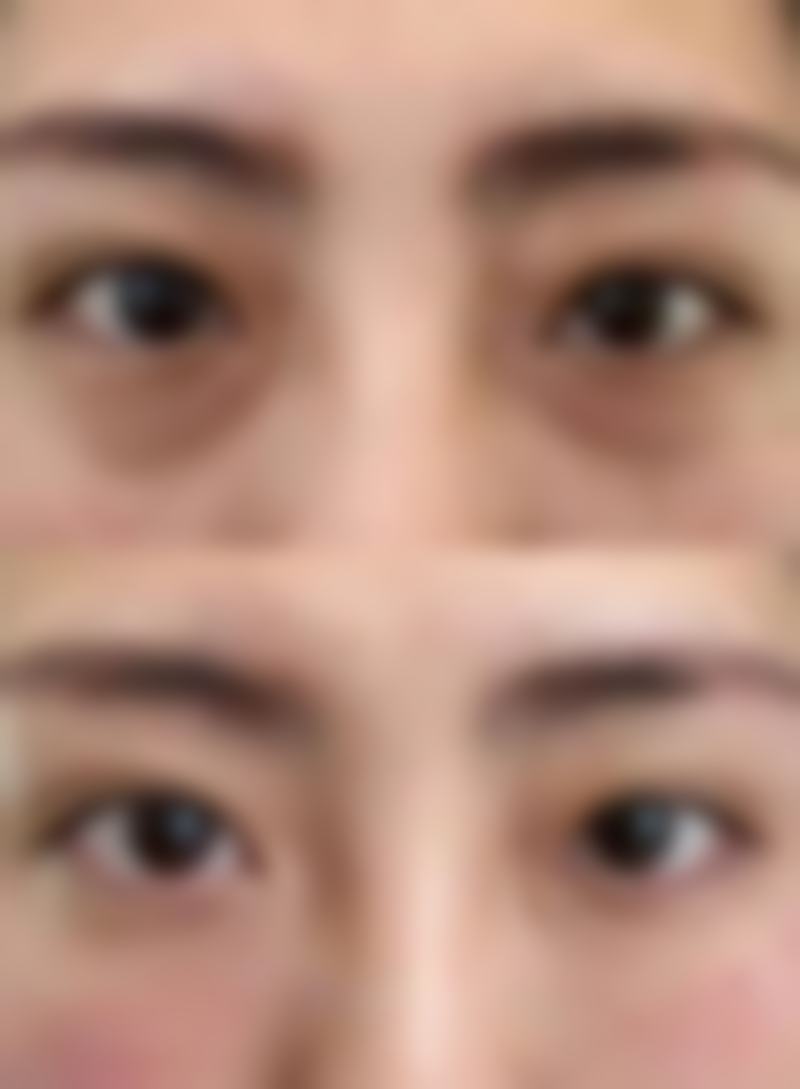 毛囊不够时的解决办法