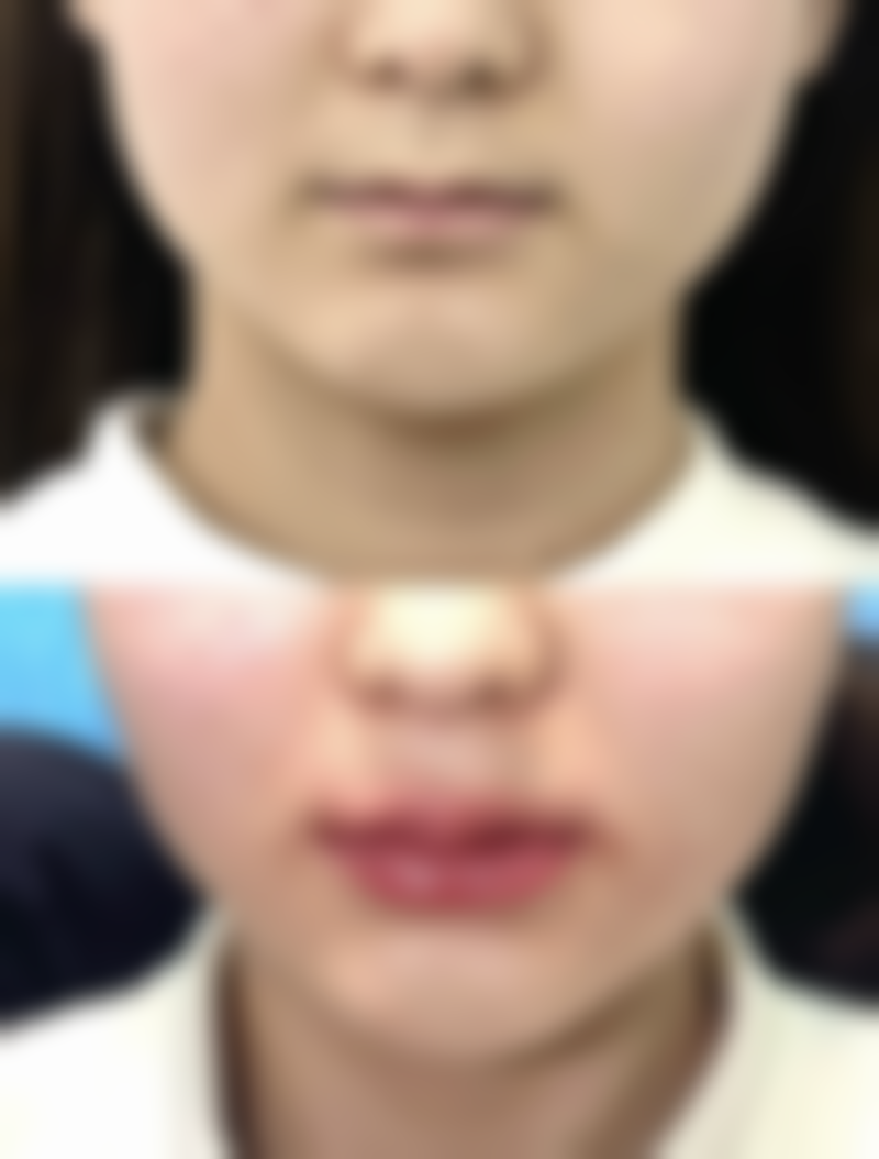 女人小阴唇缩小的日常护理建议有哪些