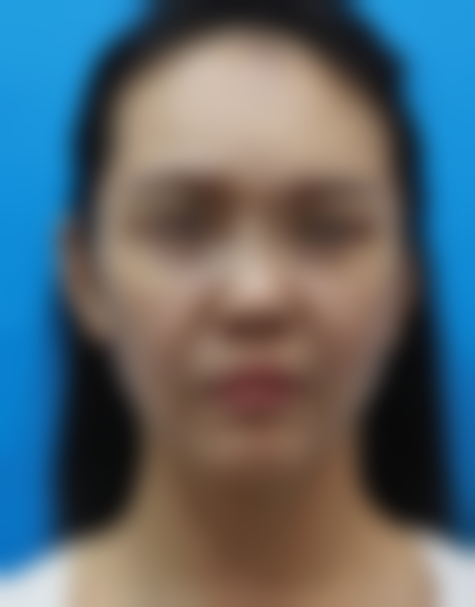 北京加减美组织提拉面部紧致项目靠谱吗？穆宝安医生手术让我松垮脸重回紧致年轻态