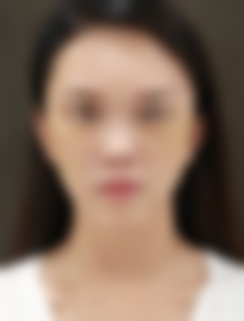 北京加减美医疗美容门诊部的组织提拉面部紧致项目,术后成效如何?