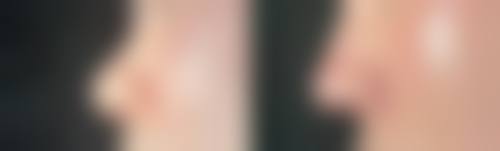 注射隆胸取出的相关情况